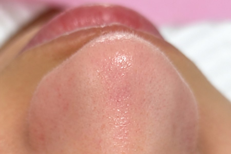Facial treatment after - Clinica Leen