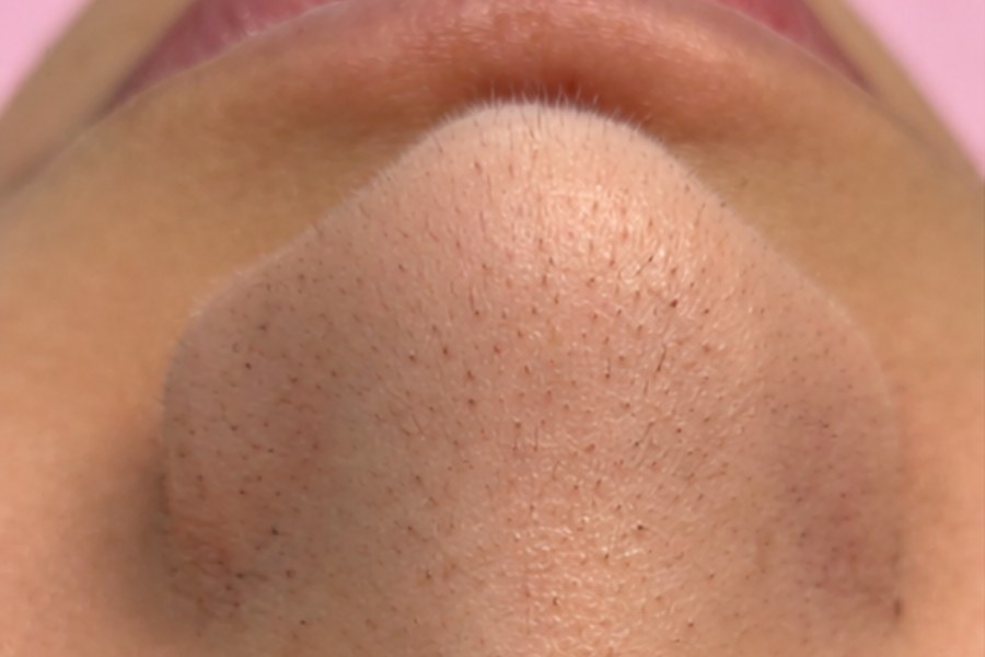Facial treatment before - Clinica Leen