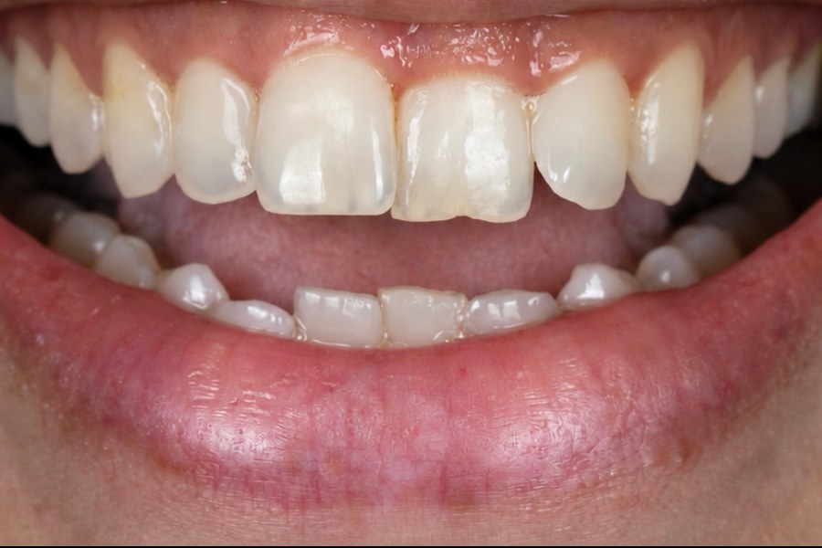 Smile before veneers and aligners - Clinica Leen